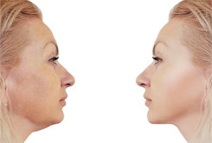 neck liposuction cost