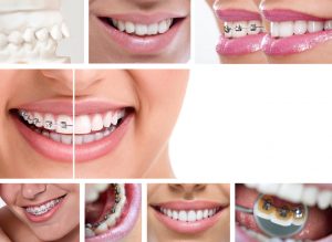 lingual braces vs invisalign cost