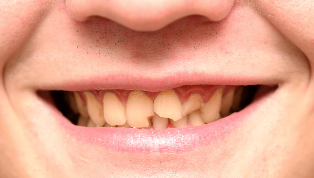 temporary filling for broken tooth