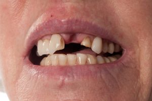 tooth knocked out of position