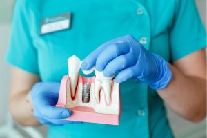 post dental implant care